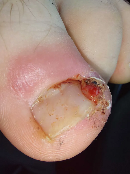 File:Toe 1.webp