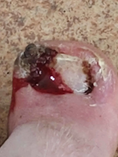 File:Toe 5.webp