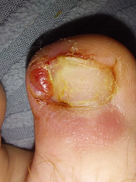 File:Toe 4.webp