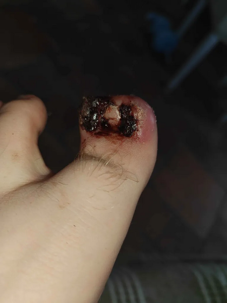 File:Toe 6.webp